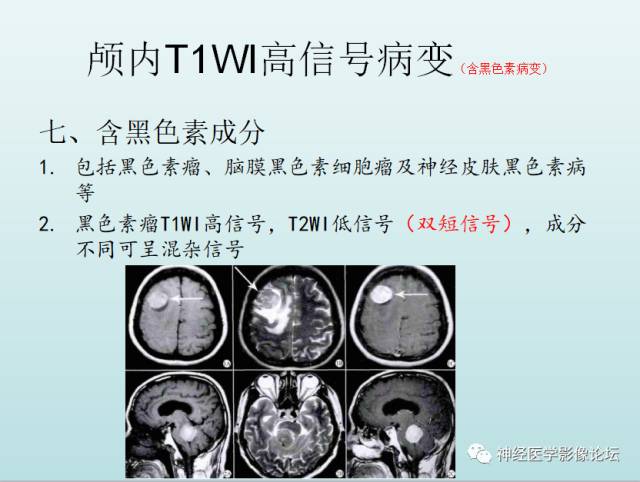 【PPT】颅内T1WI高信号病变汇总