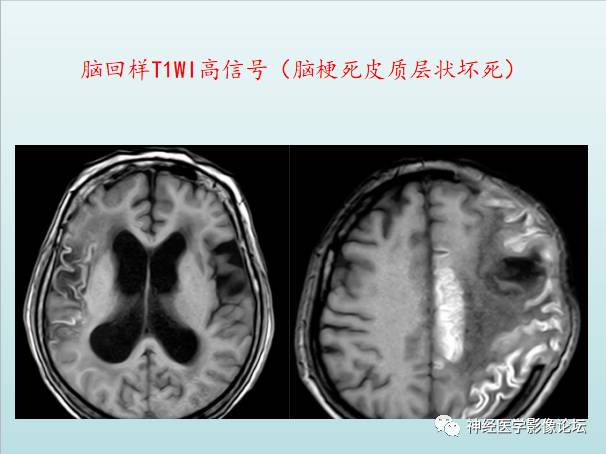 【PPT】颅内T1WI高信号病变汇总