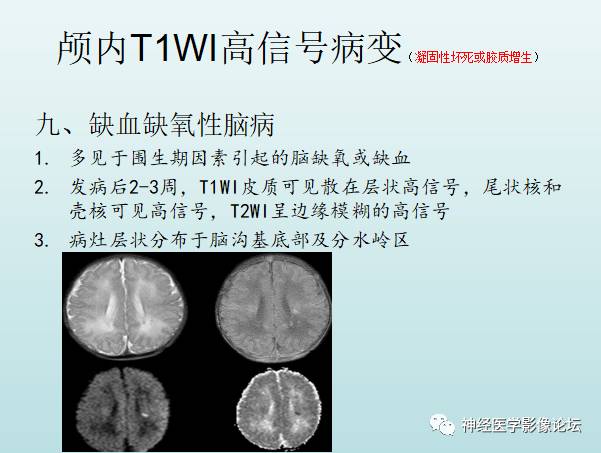 【PPT】颅内T1WI高信号病变汇总