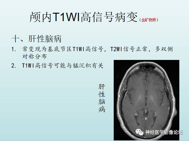 【PPT】颅内T1WI高信号病变汇总