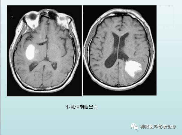 【PPT】颅内T1WI高信号病变汇总