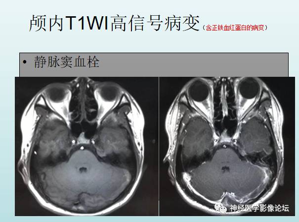 【PPT】颅内T1WI高信号病变汇总