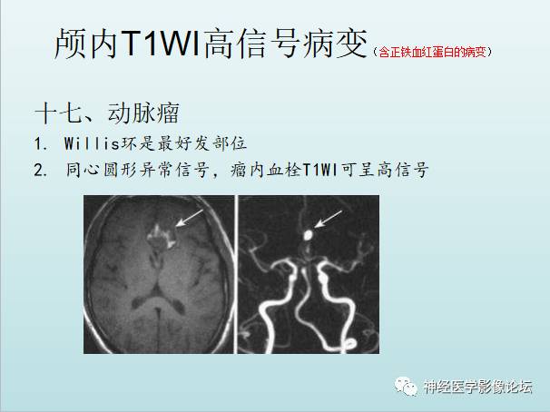 【PPT】颅内T1WI高信号病变汇总