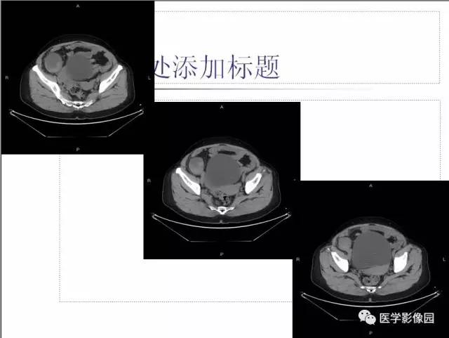 【病例】小肠胃肠道间质瘤1例CT