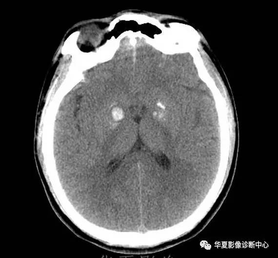 基底节少量出血与钙化鉴别