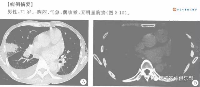 【病例】肺梗死1例CT影像表现