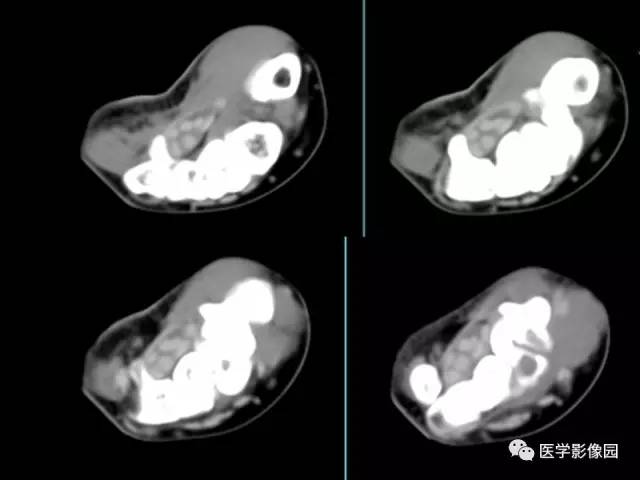 【病例】右腕腱鞘巨细胞瘤1例CT及MR影像特点