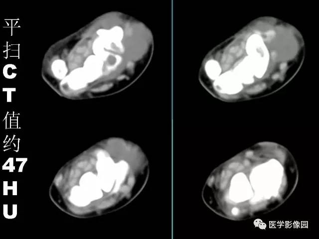 【病例】右腕腱鞘巨细胞瘤1例CT及MR影像特点
