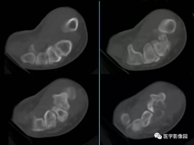 【病例】右腕腱鞘巨细胞瘤1例CT及MR影像特点