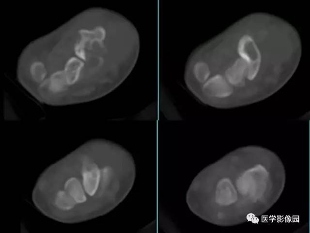 【病例】右腕腱鞘巨细胞瘤1例CT及MR影像特点