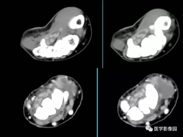 【病例】右腕腱鞘巨细胞瘤1例CT及MR影像特点