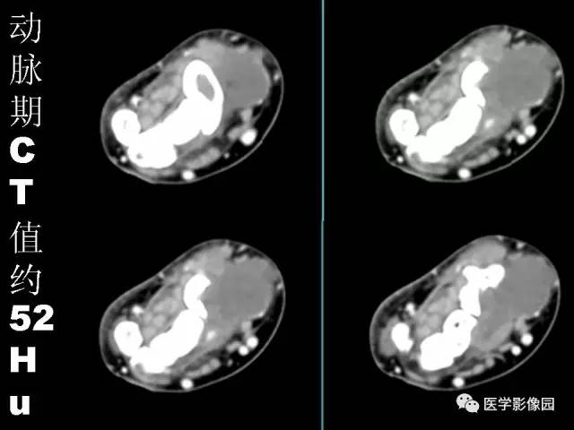 【病例】右腕腱鞘巨细胞瘤1例CT及MR影像特点