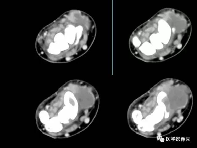 【病例】右腕腱鞘巨细胞瘤1例CT及MR影像特点