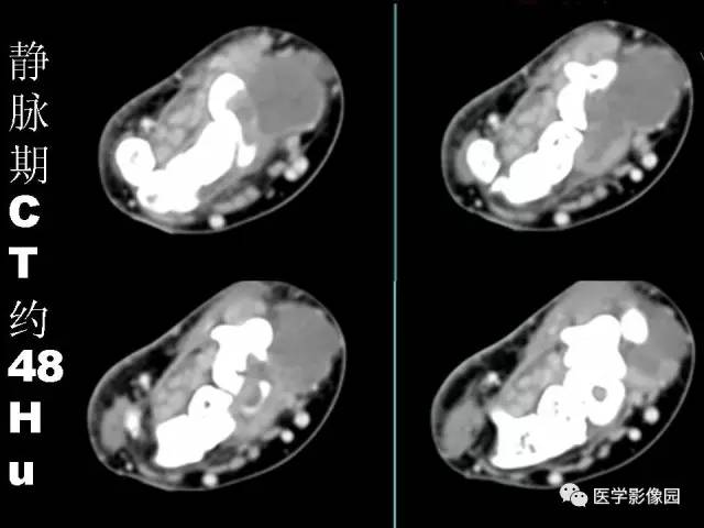 【病例】右腕腱鞘巨细胞瘤1例CT及MR影像特点