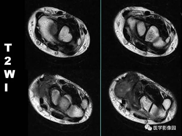 【病例】右腕腱鞘巨细胞瘤1例CT及MR影像特点