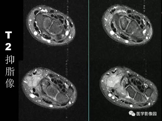 【病例】右腕腱鞘巨细胞瘤1例CT及MR影像特点