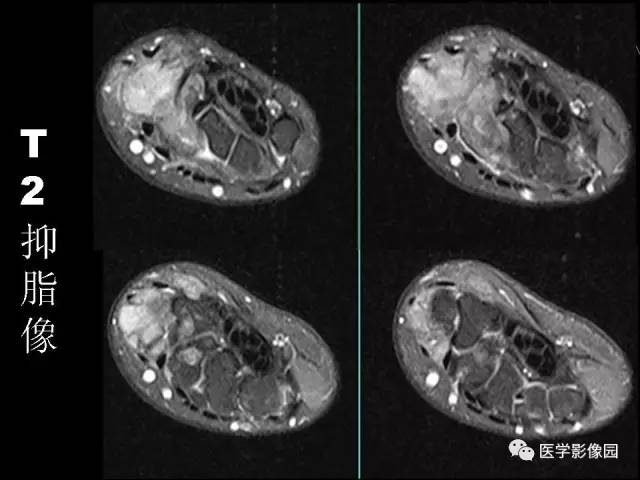 【病例】右腕腱鞘巨细胞瘤1例CT及MR影像特点