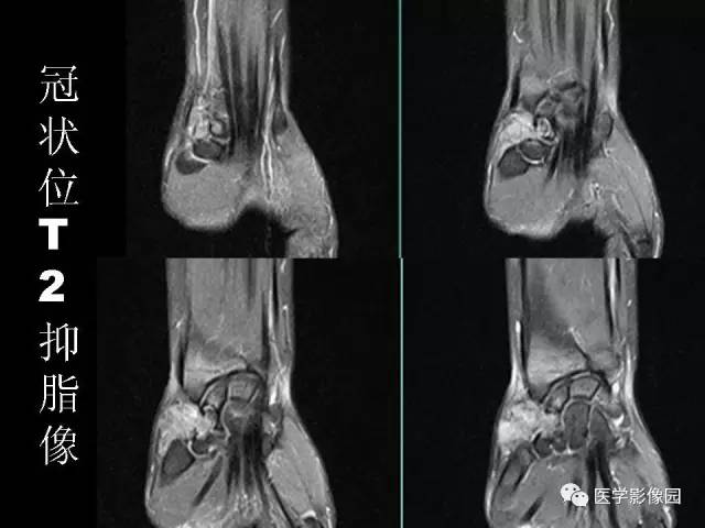 【病例】右腕腱鞘巨细胞瘤1例CT及MR影像特点