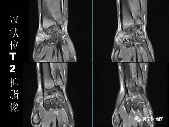 【病例】右腕腱鞘巨细胞瘤1例CT及MR影像特点