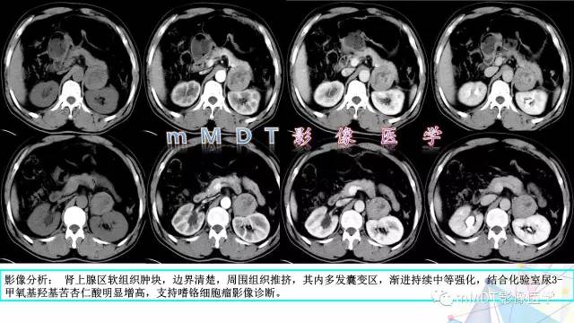 【PPT】肾上腺嗜铬细胞瘤影像诊断