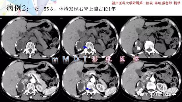 【PPT】肾上腺嗜铬细胞瘤影像诊断