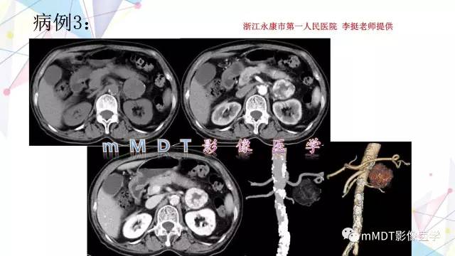 【PPT】肾上腺嗜铬细胞瘤影像诊断