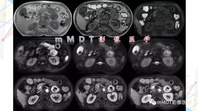 【PPT】肾上腺嗜铬细胞瘤影像诊断