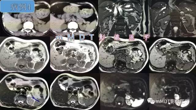 【PPT】肾上腺嗜铬细胞瘤影像诊断