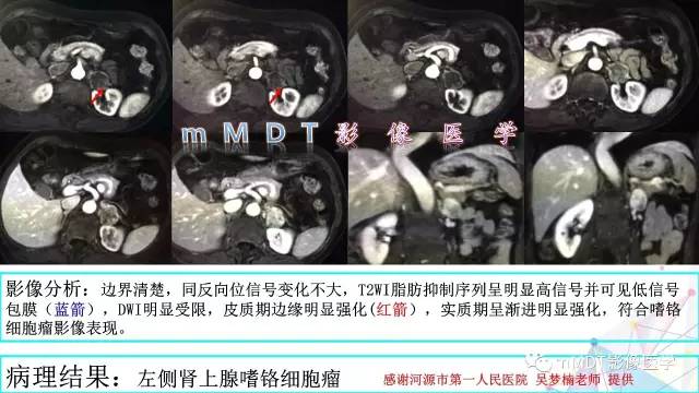 【PPT】肾上腺嗜铬细胞瘤影像诊断