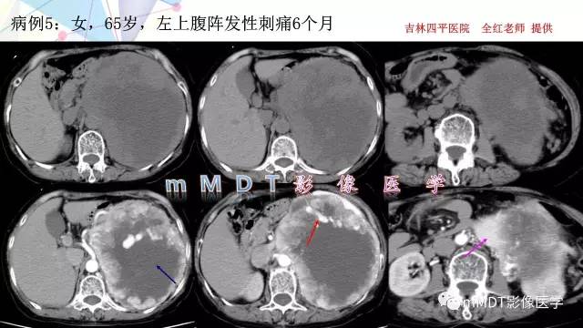 【PPT】肾上腺嗜铬细胞瘤影像诊断