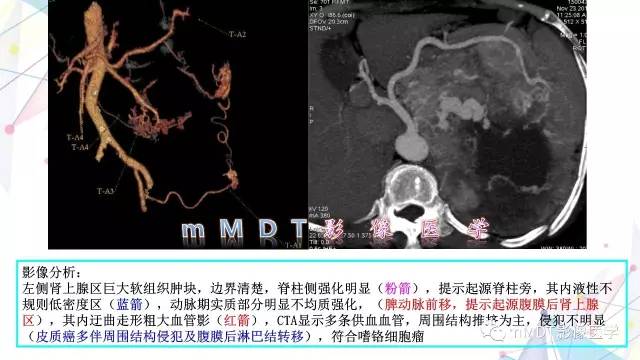 【PPT】肾上腺嗜铬细胞瘤影像诊断
