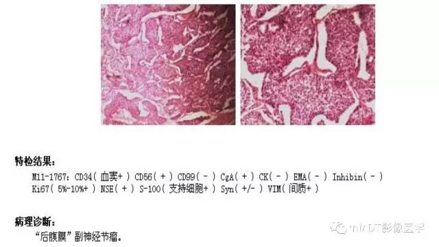 【PPT】肾上腺嗜铬细胞瘤影像诊断