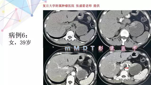 【PPT】肾上腺嗜铬细胞瘤影像诊断