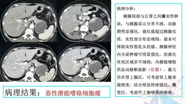 【PPT】肾上腺嗜铬细胞瘤影像诊断