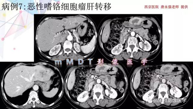 【PPT】肾上腺嗜铬细胞瘤影像诊断