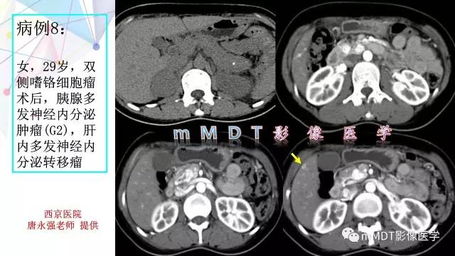 【PPT】肾上腺嗜铬细胞瘤影像诊断