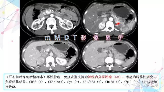 【PPT】肾上腺嗜铬细胞瘤影像诊断