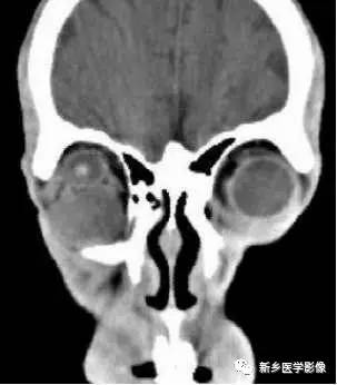 眼球内17种疾病影像表现汇总 眼球内17种疾病影像表现汇总