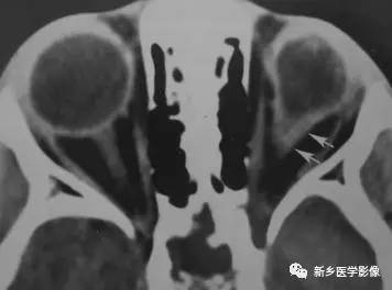 眼球内17种疾病影像表现汇总 眼球内17种疾病影像表现汇总