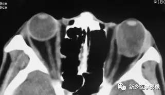 眼球内17种疾病影像表现汇总 眼球内17种疾病影像表现汇总