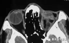 眼球内17种疾病影像表现汇总 眼球内17种疾病影像表现汇总