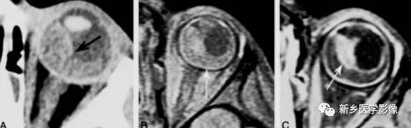 眼球内17种疾病影像表现汇总 眼球内17种疾病影像表现汇总