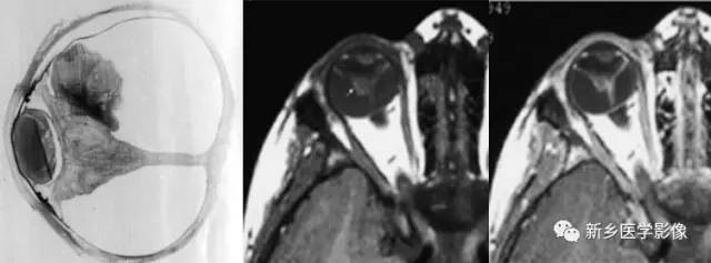 眼球内17种疾病影像表现汇总 眼球内17种疾病影像表现汇总