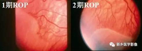 眼球内17种疾病影像表现汇总 眼球内17种疾病影像表现汇总