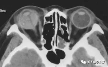 眼球内17种疾病影像表现汇总 眼球内17种疾病影像表现汇总