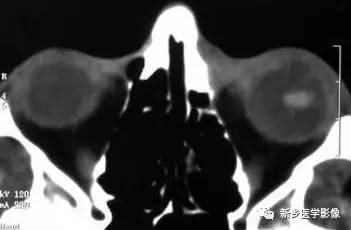 眼球内17种疾病影像表现汇总 眼球内17种疾病影像表现汇总
