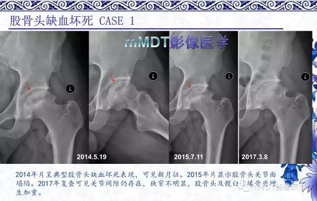 【PPT】髋关节部分常见病变的鉴别诊断