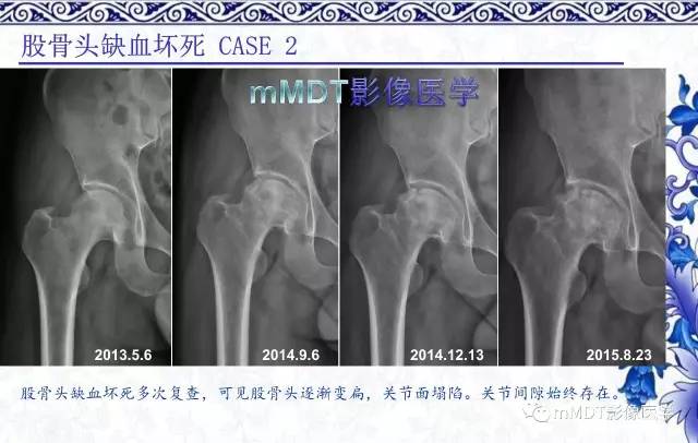 【PPT】髋关节部分常见病变的鉴别诊断