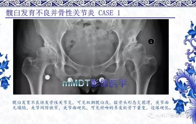 【PPT】髋关节部分常见病变的鉴别诊断