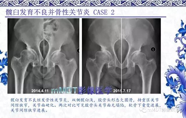 【PPT】髋关节部分常见病变的鉴别诊断